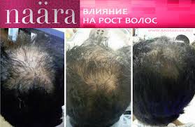 Naara влияние на рост волос на фото головы мужчины изменения в лучшую сторону. Picture