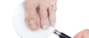 Чем лечить грибок ногтей – лучшие средства полный обзор
