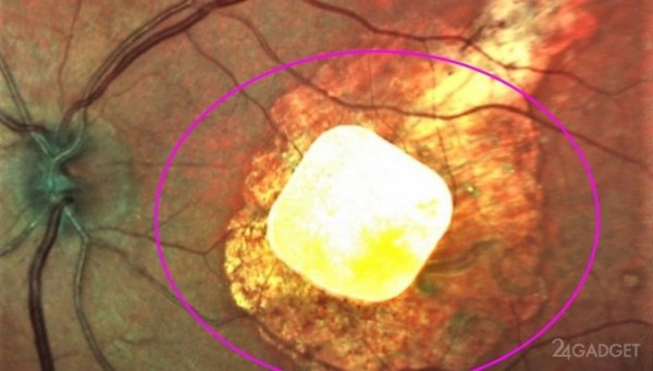Крошечный имплантат способен вернуть утраченное с возрастом зрение (2 фото)