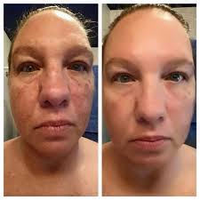 jeunesse-instantly-ageless-acne-effect, лицо женщины до и после применения крема Instantly Ageless, эффект. Picture.